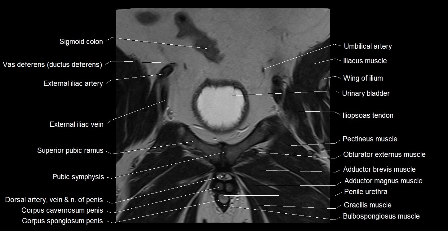 MRI coronal cross sectional anatomy male pelvis image 11.webp